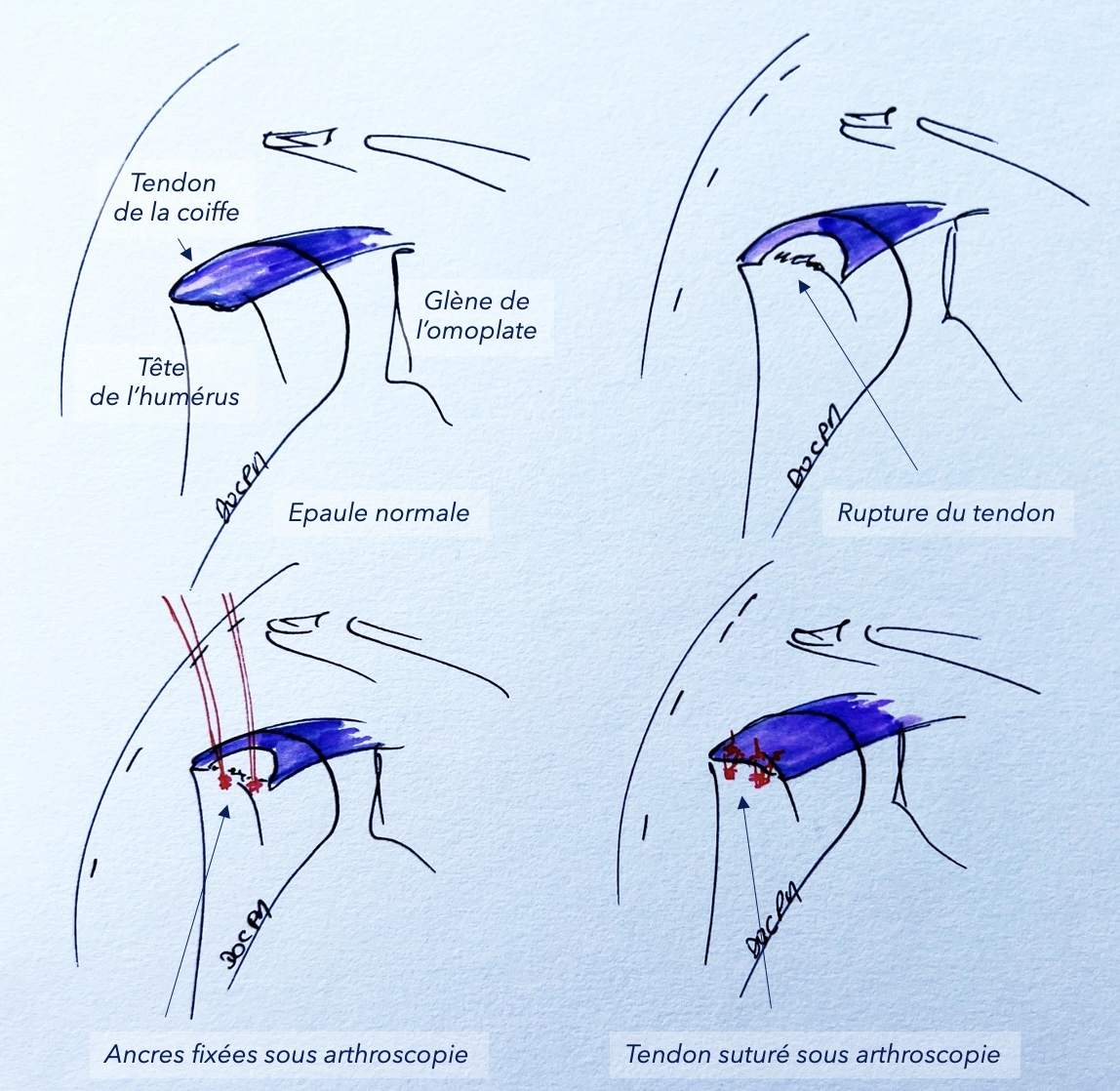 schéma_chirurgie_épaule_sous_arthroscopie - Clinique PLAINE santé Clermont-Ferrand (63)